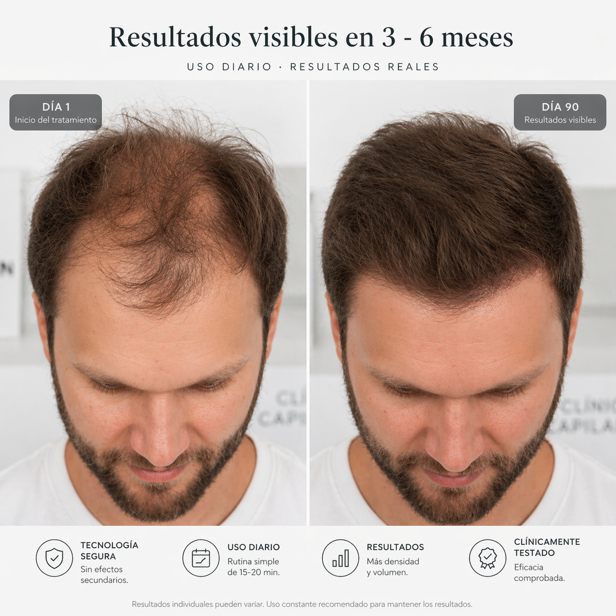 Capilarum X1 — Sistema de estimulación capilar en casa